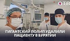 Гигантский полип удалили пациенту в Бурятии