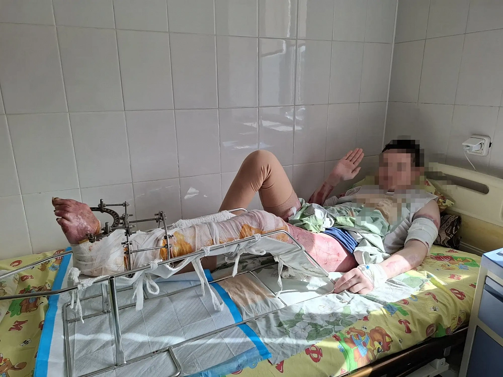 В Бурятии хирурги ДРКБ спасли ноги подростку после ДТП с возгоранием